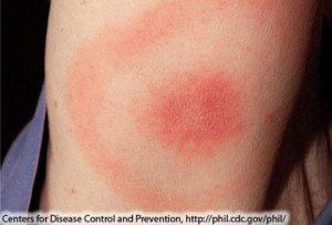"Bull's Eye" rash, a tell-tale symptom of Lyme Disease