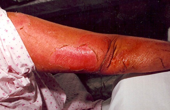 Phototoxic burn on upper arm after Bergamot oil was applied before exposure to tanning bed. 